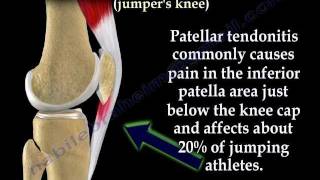 Patellar Tendonitis Jumpers Knee  Everything You Need To Know  Dr Nabil Ebraheim [upl. by Endres]