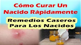 REMEDIOS CASEROS PARA LOS NACIDOS Como Curar Un Nacido Rápidamente [upl. by Eimmak]