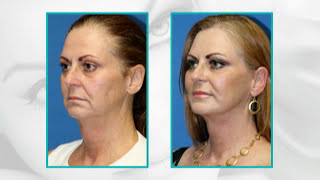 Facial Plastic Surgery Before and After 15 Years Younger Facelift facial fat transfer eyelid [upl. by Eiznek]