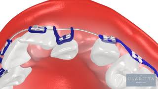 Oque é Ortodontia Como funciona um Aparelho Ortodôntico ortodontia invisalign clinicajin [upl. by Hephzipah166]