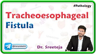 1 Tracheoesophageal Fistula  USMLE Step 1 Pathology [upl. by Marcia]