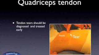 Quadriceps Tendon Tear [upl. by Yblok]