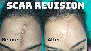 Scar revision surgery  Result after 2 Weeks Laser scar revision surgery in Ranchi scar scaron [upl. by Netsirhk117]