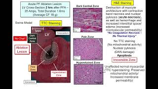 PR2023 MARCH 20  Ablation of supraventricular arrhythmias 1 [upl. by Ggerc746]