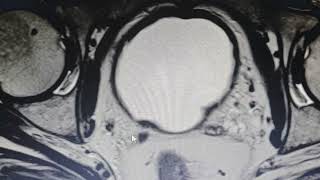 Rare unilateral agenesis of a seminal vesicle  MRI findings [upl. by Svensen]