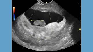 Fetal demise in 1st trimester of pregnancy or miscarriage ultrasound and color Doppler video [upl. by Eniamor]