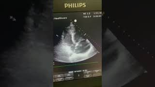 Horrifying Floating RA THROMBUS 😱😲 echocardiography echocardiogram cardio thrombus cardiology [upl. by Natsirk]