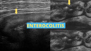 Enterocolitis  Ultrasound Case [upl. by Pacificas]