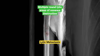 Lytic metastasis from lung cancer 🫁radiology radiologyfundamentals metastasis [upl. by Ahsat]