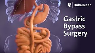 Gastric Bypass Surgery  Duke Health [upl. by Tingley]