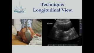 First Trimester Pregnancy Ultrasound [upl. by Stilla]