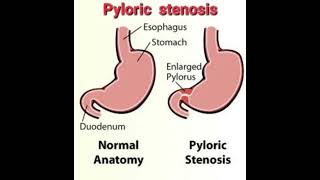 Pyloric stenosis Fluid calculation mrcpch Recall Communication [upl. by Mazel]