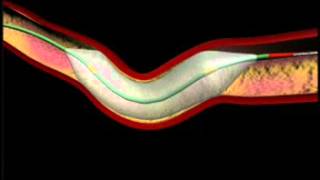 Balloon Angioplasty and Stenting Animation [upl. by Beltran]