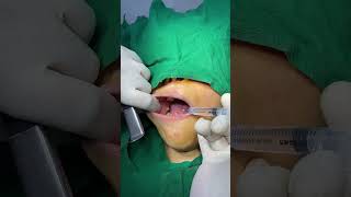 Buccal Fat Removal  Face Slimming Treatment in Navi Mumbai by Dr Arun Panda [upl. by Egiarc676]