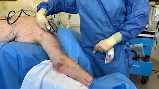 THINNER SLENDER WRISTS WITH HDLIPO TO THE FOREARM  FEMALE BODY ARM TRANSFORMATIONDr Jason Emer [upl. by Nyl]