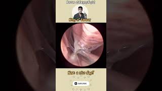 귀지형 콧물 부비동염 축농증 비염 코청소 이비인후과 rhinorrhea rhinitis sinusitis asmr ENT ENTdoctor [upl. by Finbur]