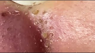 TOP OF BLACKHEADS REMOVAL FROM THE NOSE 😨 relaxing blackheads [upl. by Lisabet]