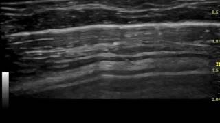 Ultrasonography of feline pneumothorax [upl. by Ahmed]