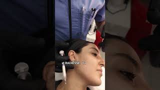 Redensificación y perfilado facial con Hidroxiapatita de calcio Radiesse [upl. by Aurita]