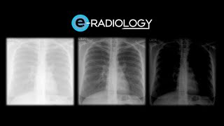 quotGrado de PENETRACIÓN en la RADIOGRAFÍA de TÓRAX Clave para una Interpretación Precisa 🔍💡quot [upl. by English]