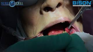 Odontogenic Fibroma Removal [upl. by Manwell]