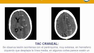 NeurorgsnetHematoma subdural crónico [upl. by Letnwahs]