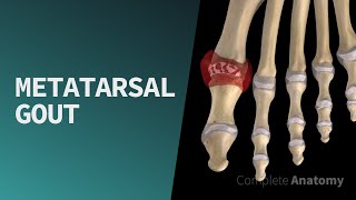 Metatarsal Gout  by Complete Anatomy [upl. by Yim]