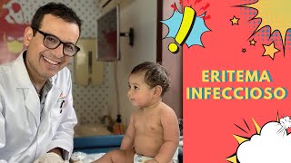 Eritema infeccioso que es y como se diagnostica [upl. by Coray]