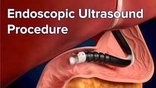 Endoscopic Ultrasound EUS Procedure  Cincinnati Childrens [upl. by Jaclin]