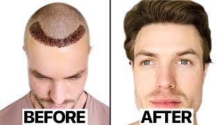 My Hair Transplant Results 6 Months  Surgeon Reacts [upl. by Ybrad178]