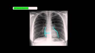 Chest XRay Reading Method  ABCDE UndergroundMed [upl. by Ayikin]