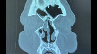 Bilateral endoscopic sinus surgery for sinusitis with polyposis [upl. by Chapa]