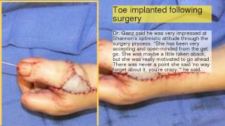 ToetoThumb Transplant [upl. by Burris530]