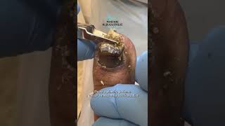 Treating a critical fungal toenail with onychomycosis 👣 fungaltoenail [upl. by Hashim737]