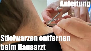 Fibrome Stielwarze schnell und schmerzfrei entfernen mit Schere beim Hausarzt [upl. by Agrippina963]