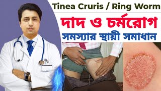 দাদ ও চুলকানি দূর করার উপায়  দাদ ও হাজার চিকিৎসা  Fungal Infection  Tinea Corporis  দাদের ওষুধ [upl. by Ryter]