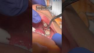 BAND amp LOOP Space maintainer oralhealth viral trending youtubeshorts kidsdentitryshorts brac [upl. by Ylicic]