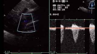 coarctation of aorta collaterals [upl. by Oinotnaesoj]