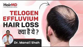 क्या है Telogen Effluvium Hair Loss  Reasons for Telogen Effluvium  HairMD Pune [upl. by Kopple]