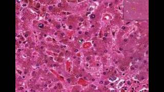 Histopathology LiverHemochromatosis [upl. by Llieno]