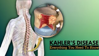 Kahlers Disease Causes Signs and Symptoms Diagnosis and Treatment [upl. by Uliram641]