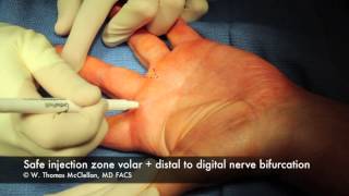 Live Surgery Digital Block Anesthesia of the Finger [upl. by Ahcire]