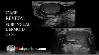 Ultrasound of Sublingual Dermoid Cyst [upl. by Cho]