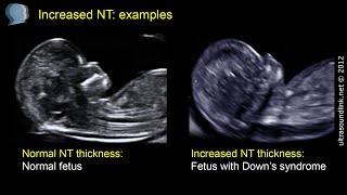 Nuchal translucency NT [upl. by Revolc]