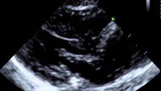 Very Fine VFib with Agonal Contractions in a 3 mo Infant [upl. by Ettenot510]