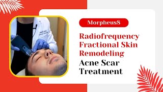 Morpheus8  Radiofrequency Fractional Skin Remodeling  Acne Scar Treatment  Jason Emer MD [upl. by Haimarej]