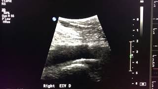 Iliac Vein Duplex Protocol Start to Finish [upl. by Otreblig578]