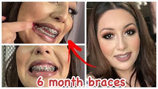 6 Month BRACES Update  OverjetOverbite  Damon Braces  Adult Braces [upl. by Ahter]