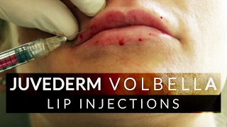 Lip Filler Juvederm Volbella Treatment [upl. by Rabelais]