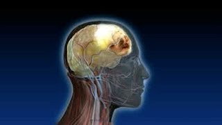 What is a Subdural Hematoma or Blood on the Brain [upl. by Nonah]